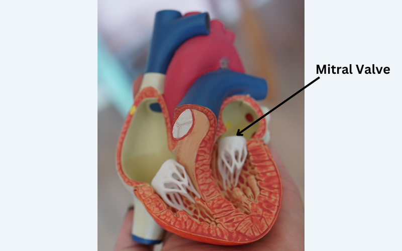 Mitral Valve Surgery